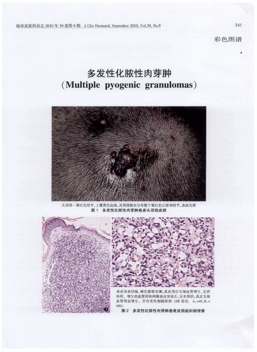 多发性化脓性肉芽肿(Multiple pyogenic granulomas)