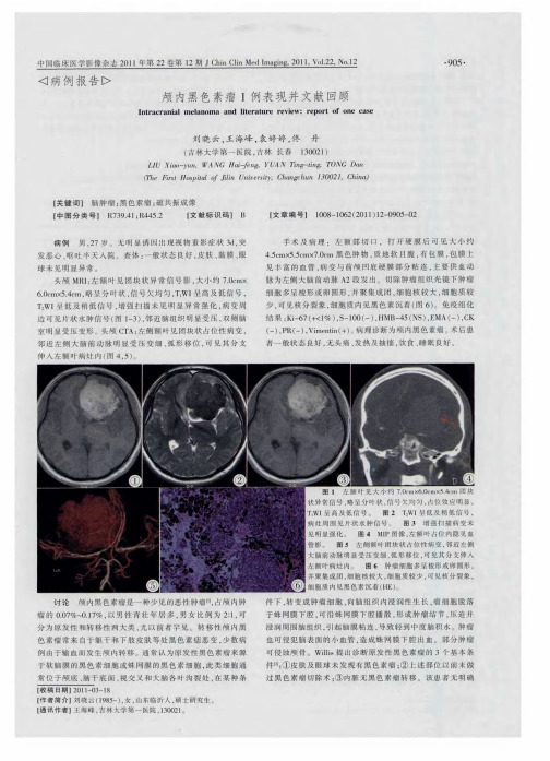 颅内黑色素瘤l例表现并文献回顾