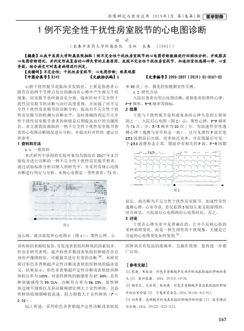 1例不完全性干扰性房室脱节的心电图诊断