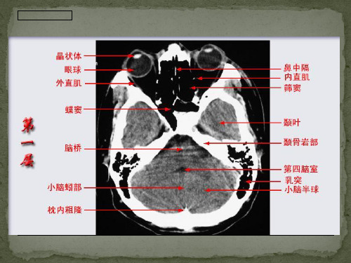 头颅CT影像解剖