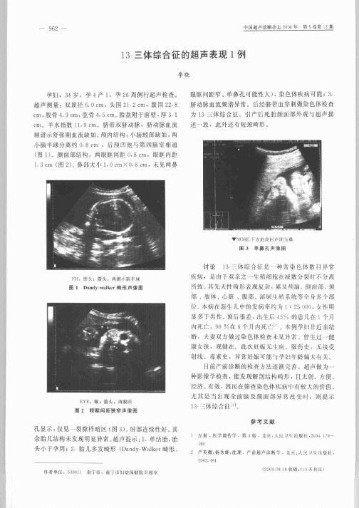 13-三体综合征的超声表现1例