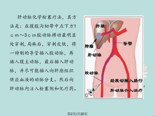 肝动脉栓塞化疗术