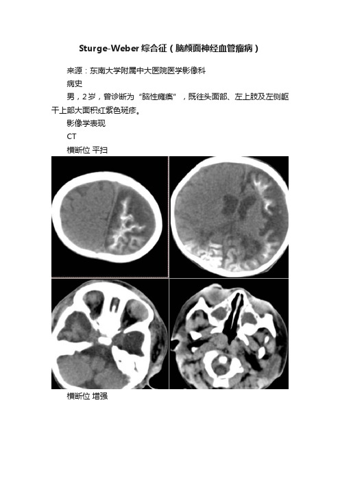 Sturge-Weber综合征（脑颜面神经血管瘤病）