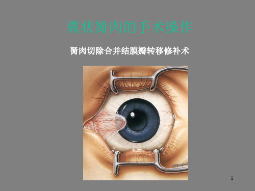 翼状胬肉的手术ppt课件