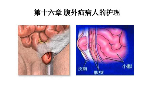 腹外疝病人的护理