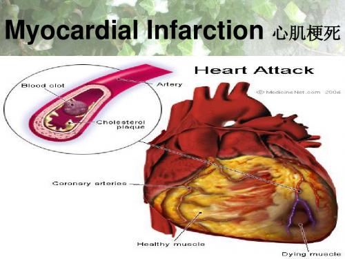 内科护理学课件 英语 考试资料myocardial infarction