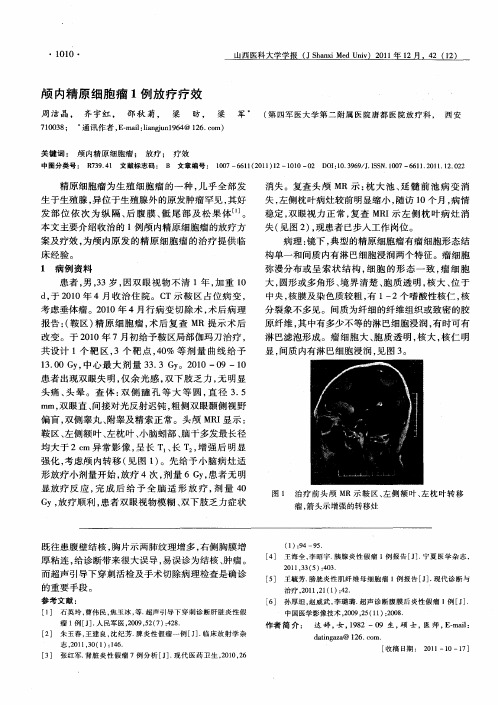 颅内精原细胞瘤1例放疗疗效