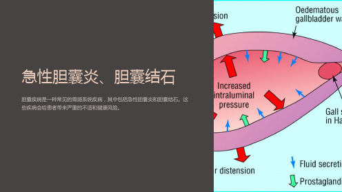 急性胆囊炎、胆囊结石