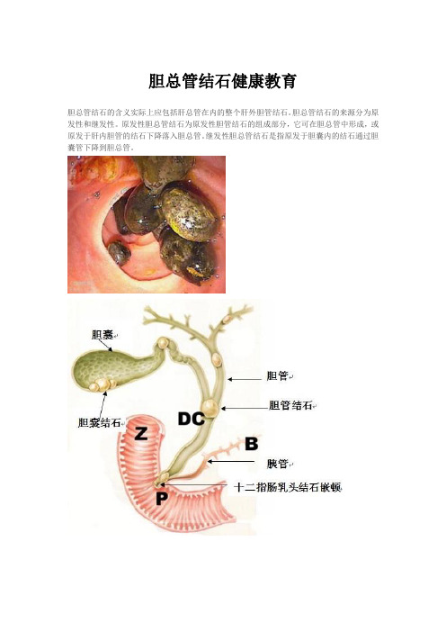 胆总管结石