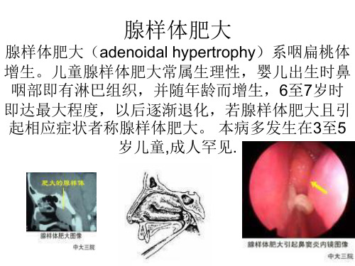 腺样体肥大