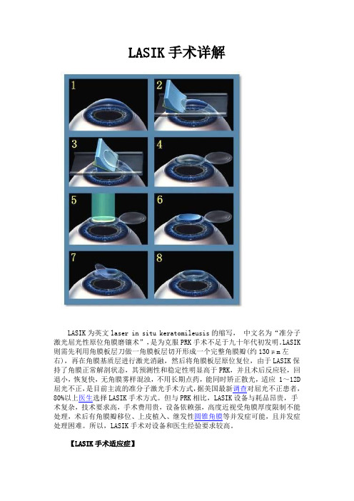 LASIK手术详解