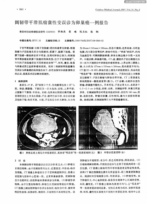 阔韧带平滑肌瘤囊性变误诊为卵巢癌一例报告