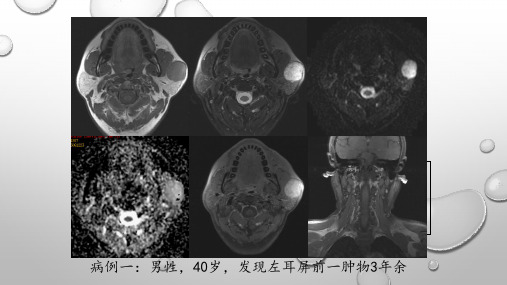 腮腺恶性肿瘤【影像科】 ppt课件