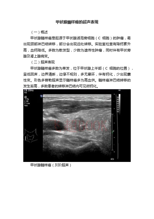 甲状腺髓样癌的超声表现