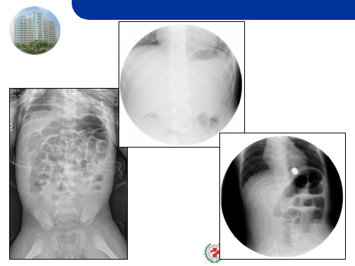 肠套叠x线诊断与复位 ppt课件