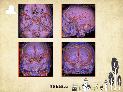 头颈部血管影像学表现