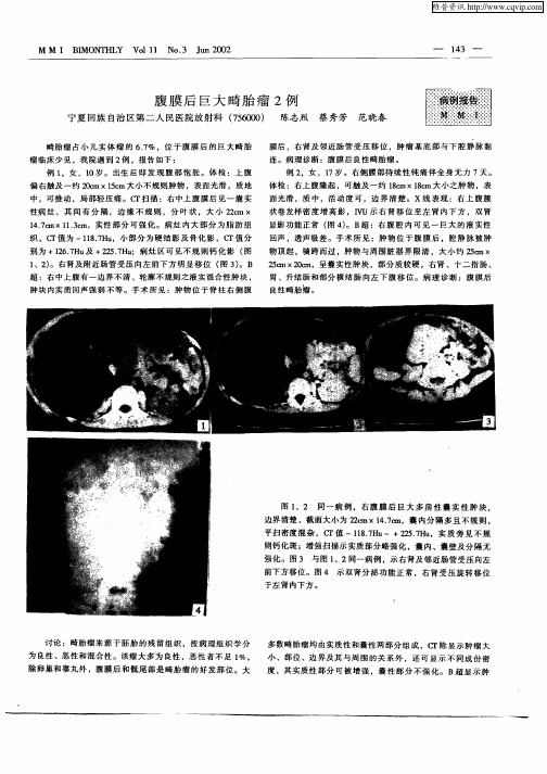 腹膜后巨大畸胎瘤2例