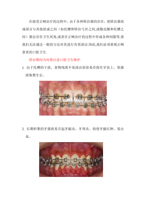 正畸治疗期间口腔卫生维护