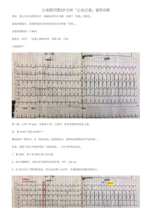 心电图识图3步分析「心动过速」鉴别诊断