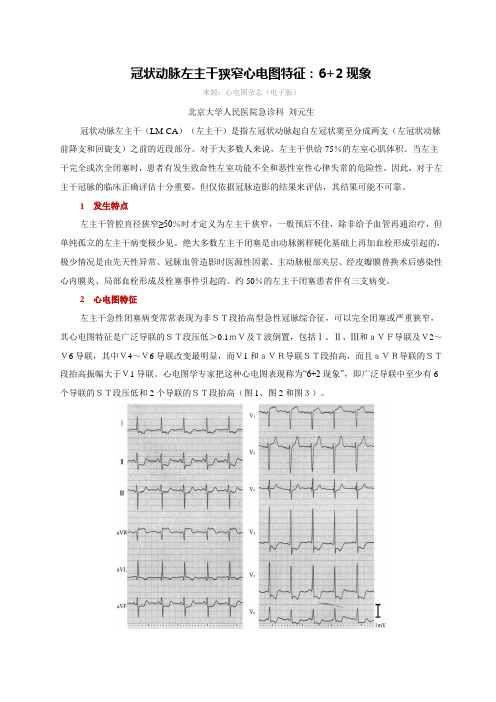 冠状动脉左主干狭窄心电图特征：6+2现象