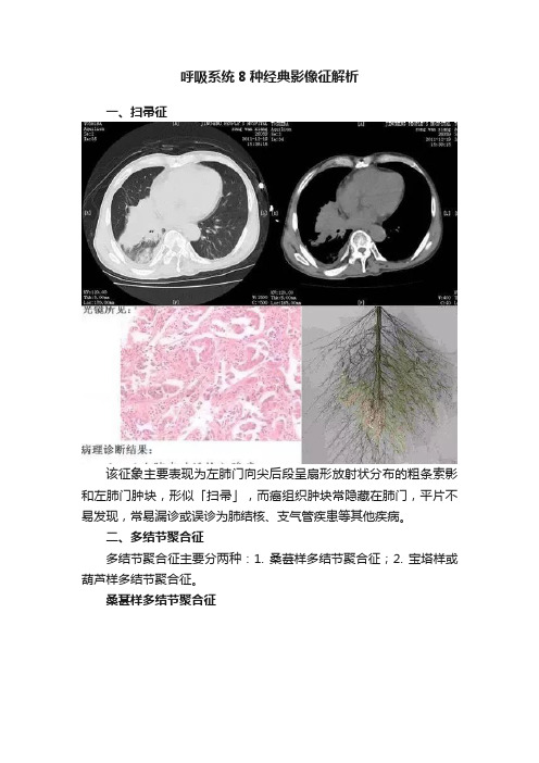 呼吸系统8种经典影像征解析