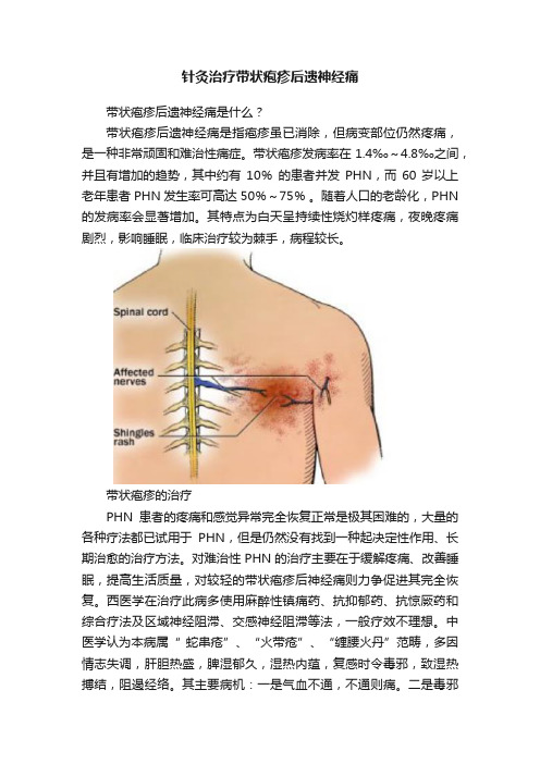 针灸治疗带状疱疹后遗神经痛