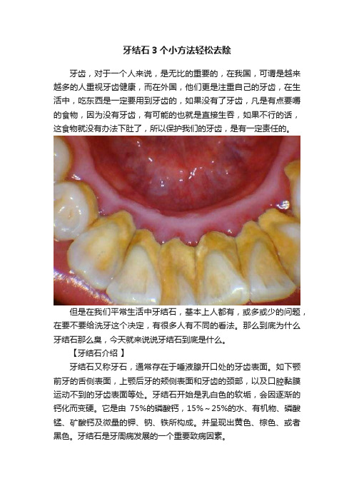 牙结石3个小方法轻松去除