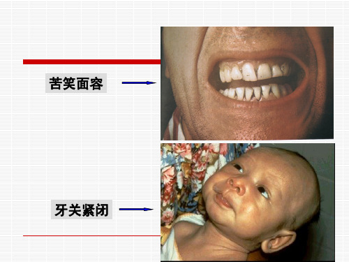 破伤风梭菌