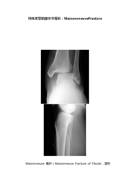 特殊类型的踝关节骨折：MaisonnneuveFracture