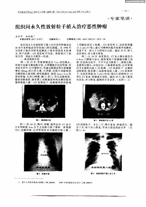 组织间永久性放射粒子植入治疗恶性肿瘤