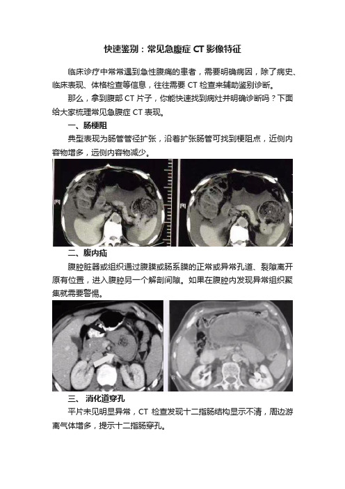 快速鉴别：常见急腹症CT影像特征