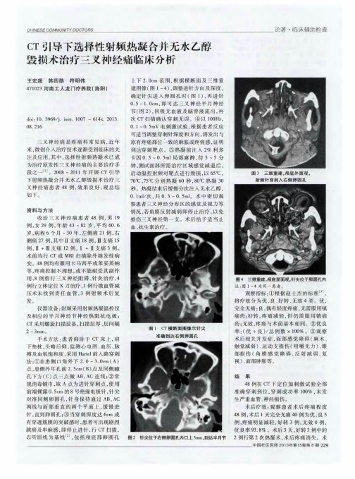 CT引导下选择性射频热凝合并无水乙醇毁损术治疗三叉神经痛临床分析