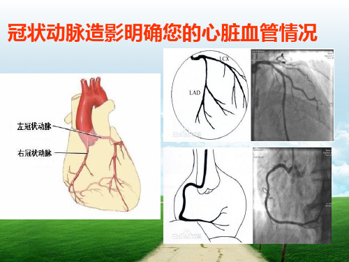 冠状动脉造影科普