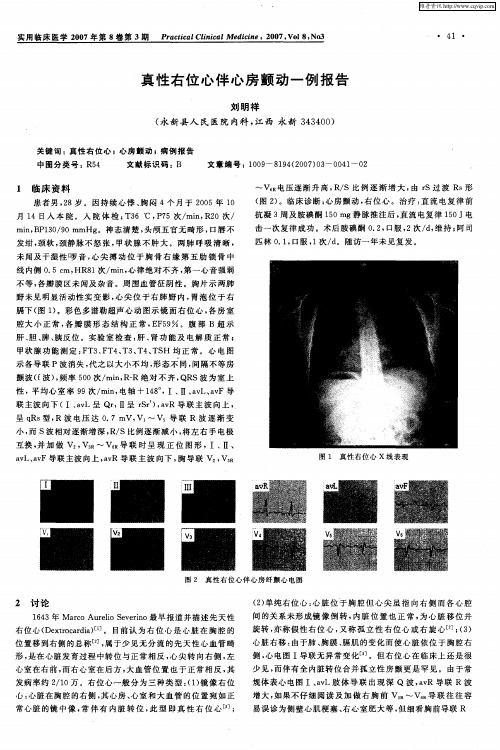 真性右位心伴心房颤动一例报告