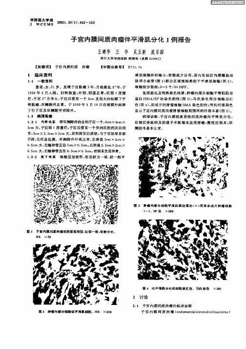 子宫内膜间质肉瘤伴平滑肌分化1例报告