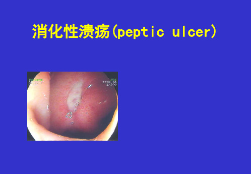 内科学课件：消化性溃疡(peptic ulcer)