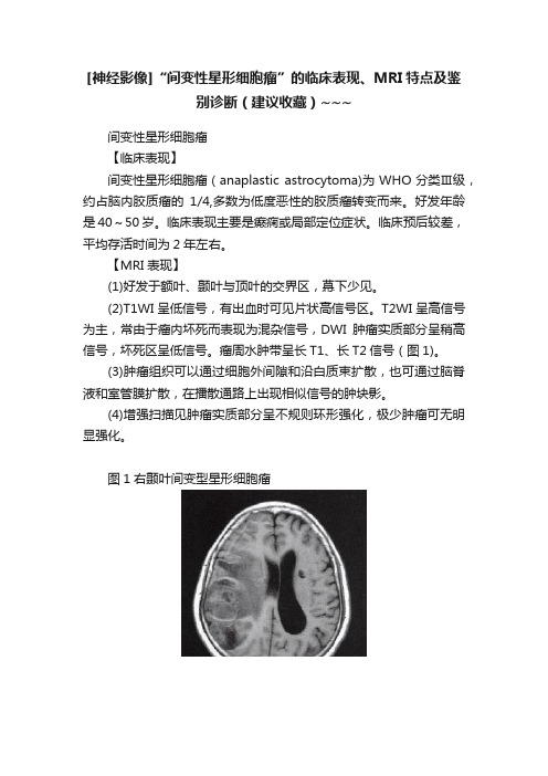 [神经影像]“间变性星形细胞瘤”的临床表现、MRI特点及鉴别诊断（建议收藏）~~~