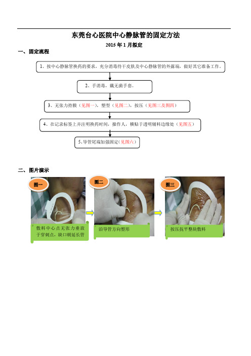 中心静脉管的固定方法