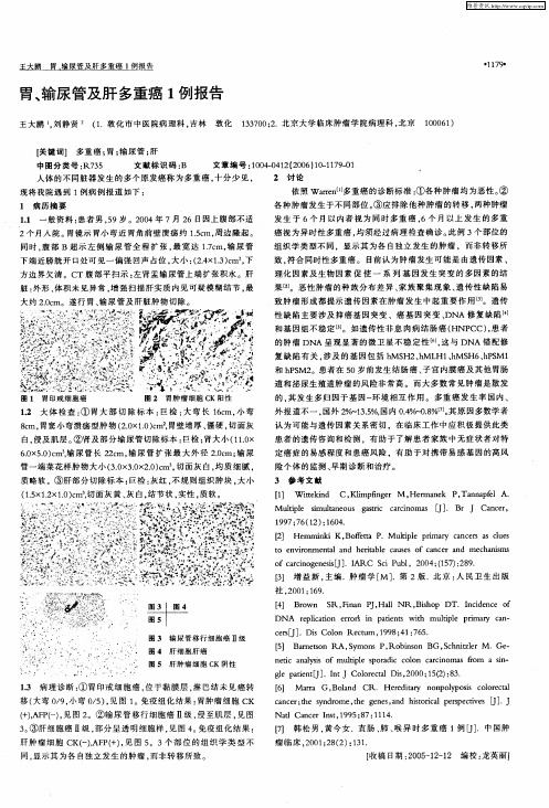 胃、输尿管及肝多重癌1例报告