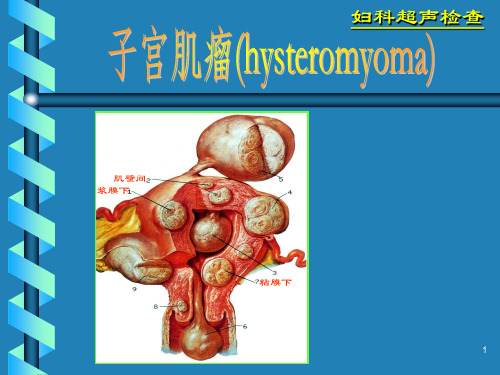 妇科超声诊断学-子宫肌瘤 PPT课件