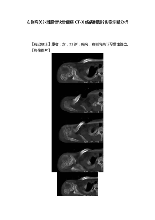 右侧肩关节滑膜骨软骨瘤病CT-X线病例图片影像诊断分析