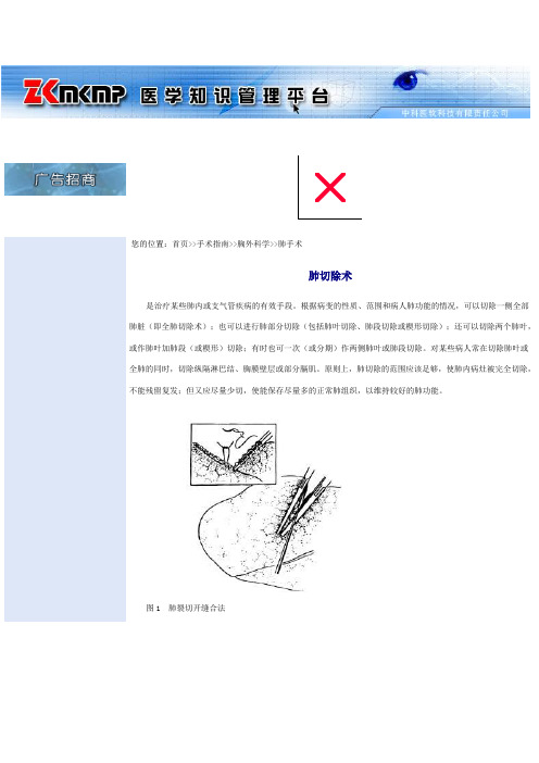 肺叶切除1