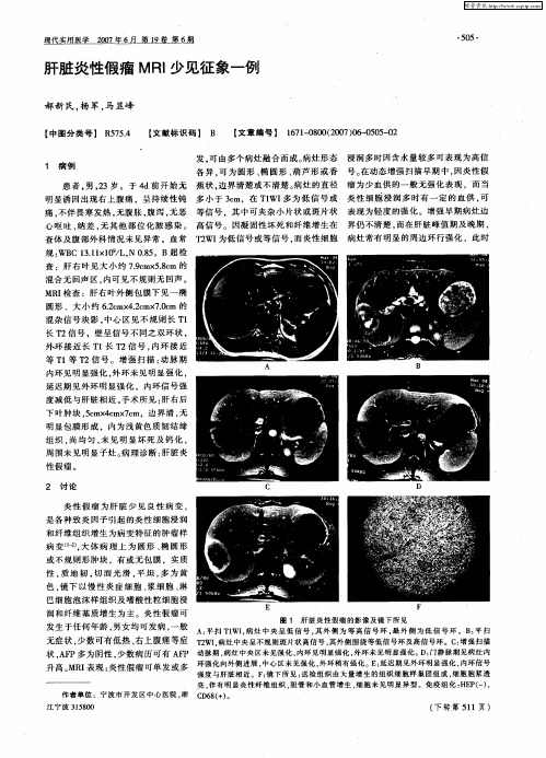 肝脏炎性假瘤MRI少见征象一例