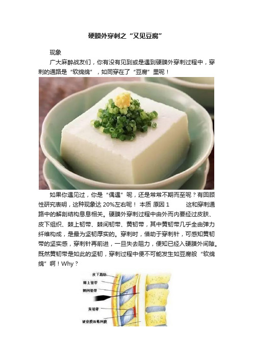 硬膜外穿刺之“又见豆腐”