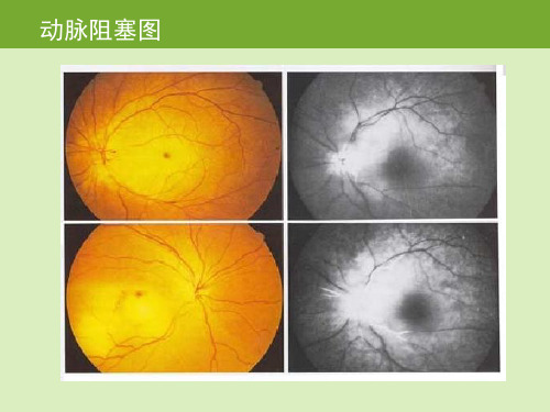 视网膜中央动、静脉阻塞 (2)PPT课件