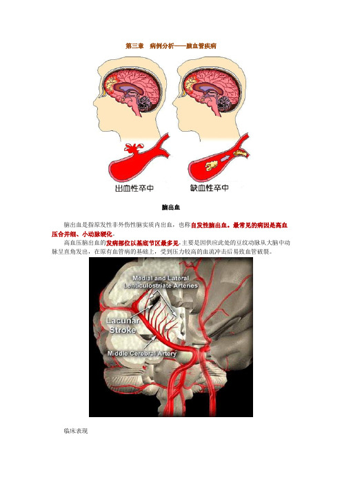 第三章 病例分析——脑血管疾病