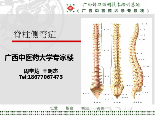 脊柱侧弯