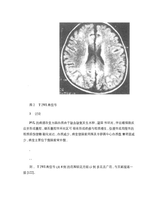 结核性脑膜炎50例脑脊液检查结果分析.