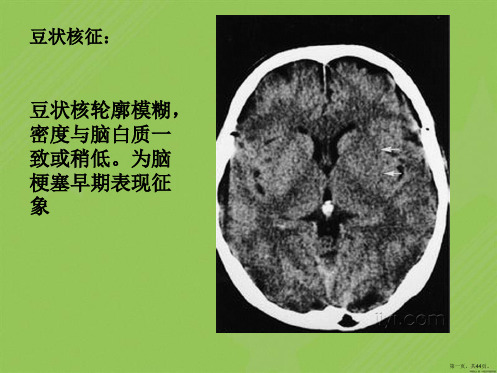 CT特殊影像