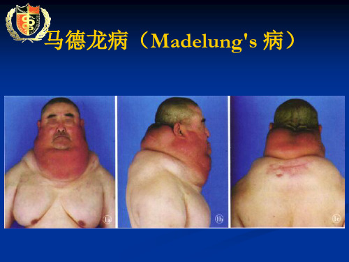 马德龙病基础知识(Madelung's disease)